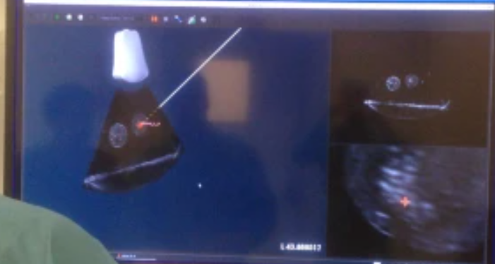Mixed reality navigation system for ultrasound-guided percutaneous punctures: a pre-clinical evaluation